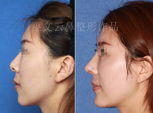 北京鼻修复性价比高的专家都有哪些？大概费用多少？