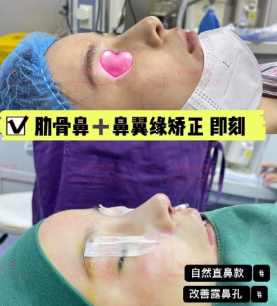 上海李章医生做的鼻子怎么样