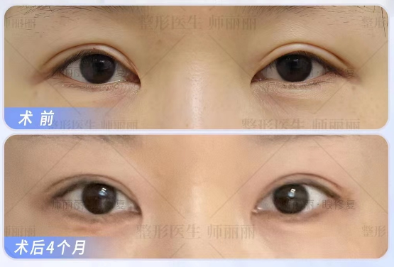 2023年北京双眼皮修复最好的专家